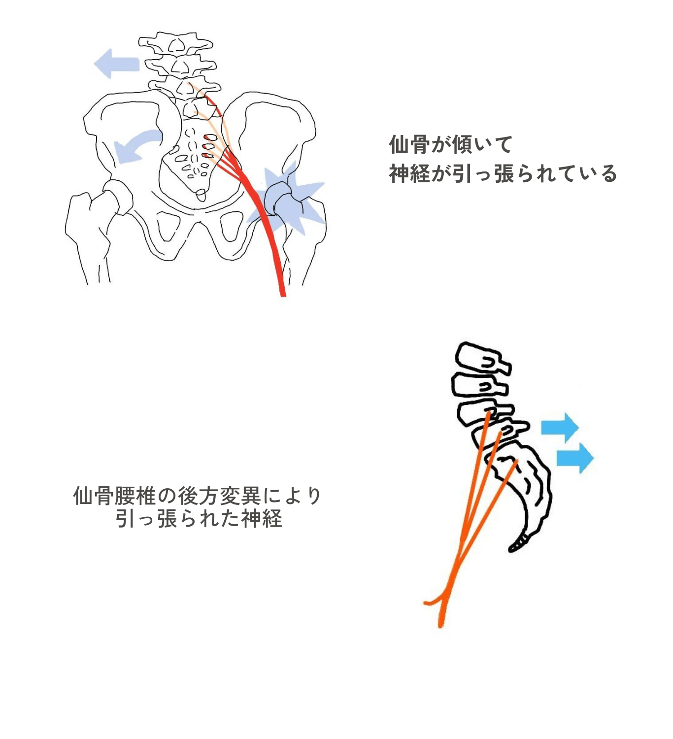 仙骨が傾いて神経が引っ張られている。仙骨腰椎の後方変異に引っ張られた神経。